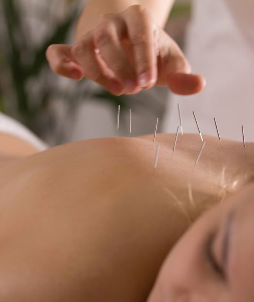 Accupuncture